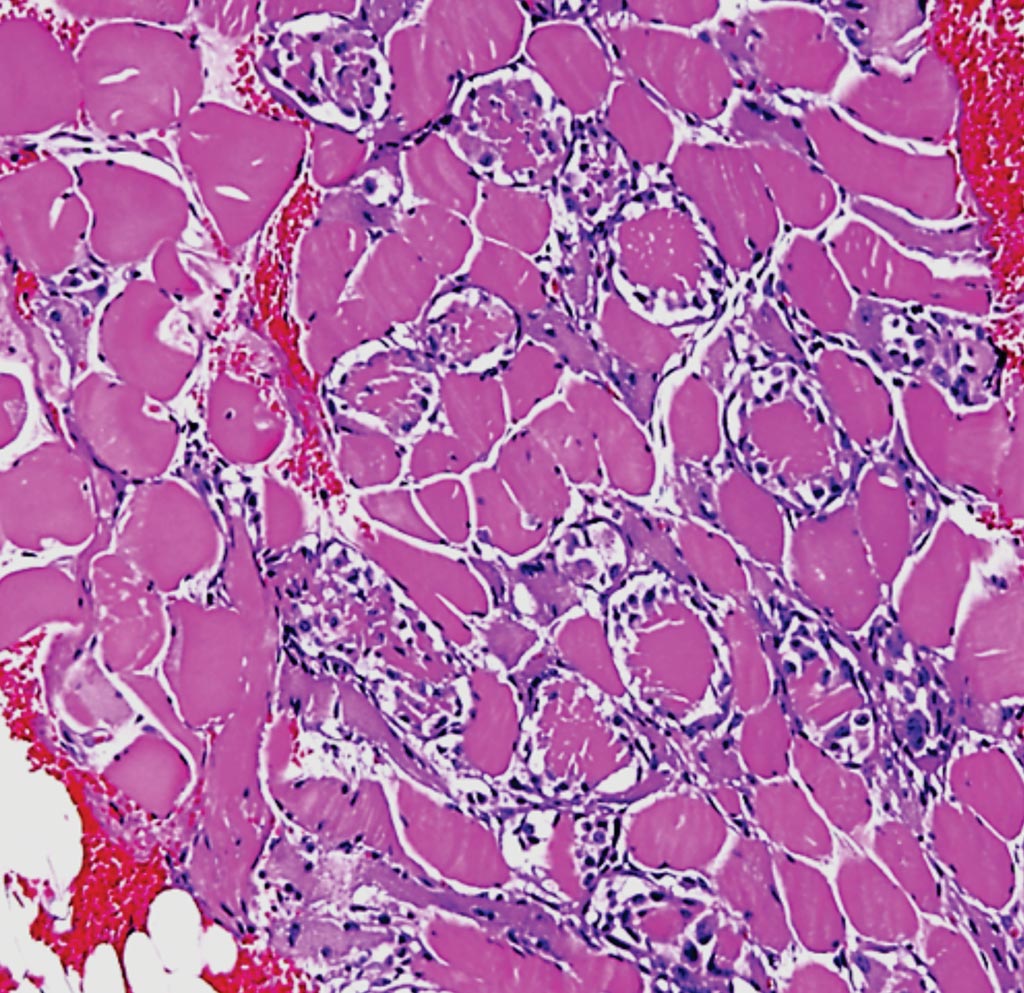 Image: A histopathology of rhabdomyolysis, a myonecrosis on a massive scale with leakage of myofiber contents, including myoglobin, creatine phosphokinase, and other proteins into the circulation (Photo courtesy of Dr. Dimitri P. Agamanolis, MD).