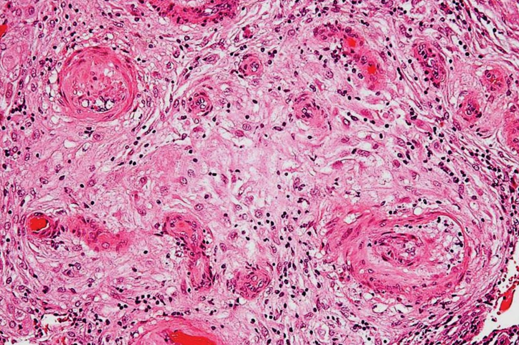 Image: A photomicrograph showing hypertrophic decidual vasculopathy, a finding seen in gestational hypertension and pre-eclampsia (Photo courtesy of Nephron).