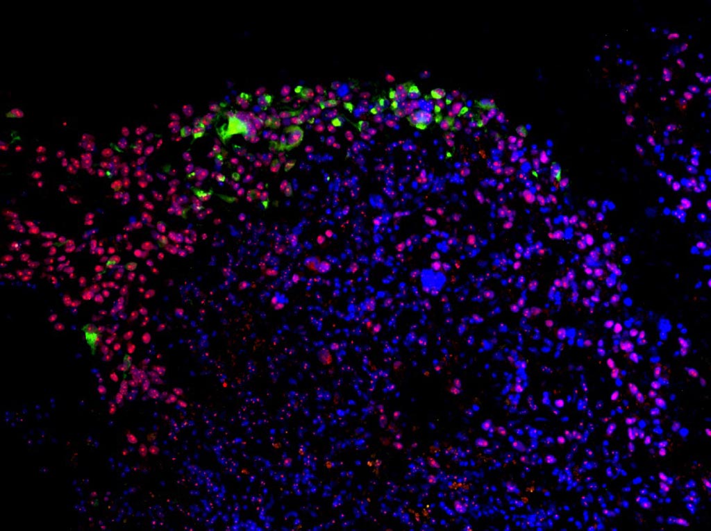Image: Zika virus (green) preferentially targets the stem cells (red) in a human glioblastoma (Photo courtesy of Zhu et al., 2017).