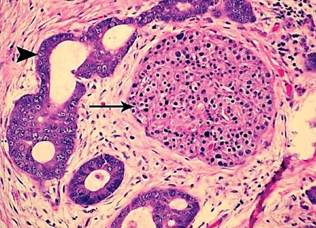 Image: A histopathology of pancreatic ductal adenocarcinoma. A moderately differentiated adenocarcinoma shows encircling of an islet and stromal desmoplasia. The desmoplasia is manifested by fibromyxoid stroma with a haphazard arrangement of cells (Photo courtesy of Pathpedia).