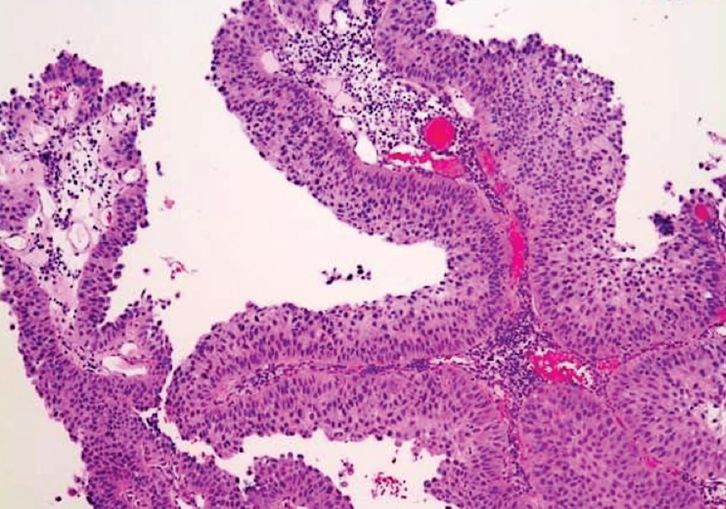 Image: Histopathology of transitional carcinoma of the urinary bladder from a transurethral biopsy. This exophytic papillary tumor shows multiple finger-like projections lined by multiple layers of urothelium (transitional epithelium) (Photo courtesy of Pathpedia).