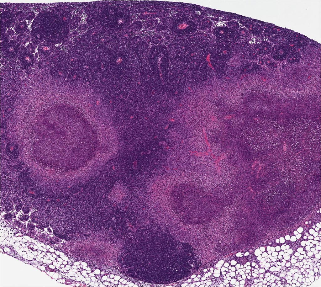 Image: Mice infected with the bacteria Yersinia pseudotuberculosis form granulomas - structures that confine pathogens. But those with a mutant form of the RIPK1 enzyme, rendering cells unable to undergo a particular form of cell death called apoptosis, do not. This RIPK1-induced apoptosis is thought to be a strategy that helps dying cells alert their neighbors that an infection is present (Photo courtesy of the University of Pennsylvania).