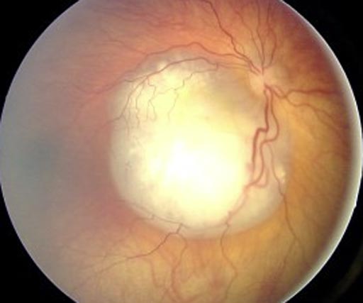 Image: An ocular fundus aspect of retinoblastoma (Photo courtesy of Wikimedia).