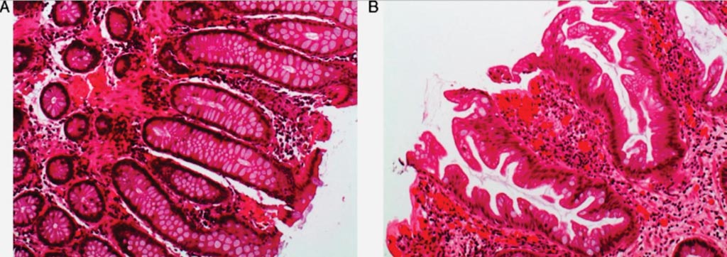 Image: The histologic appearance of serrated polyps: (A) normal colon mucosa; (B) sessile serrated adenoma with saw tooth appearance of the crypts in the longitudinal cut (Photo courtesy of Dr. Cuatrecasas).