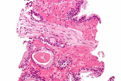 Image: A micrograph of prostatic adenocarcinoma (conventional, acinar type) with perineural invasion. Prostate biopsy, H&E stain (Photo courtesy of Wikimedia).