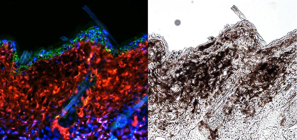 Image: Fluorescence microscopy reveals melanoma (red, left; black, right) emerging from melanocyte stem cells (Photo courtesy of Hyeongsun Moon and Andrew White, Cornell University).