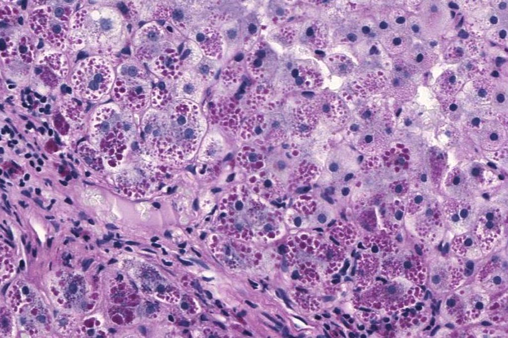 Image: A photomicrograph of a liver biopsy from a patient with alpha-1 antitrypsin deficiency. The PAS with diastase stain shows the diastase-resistant pink globules that are characteristic of this disease (Photo courtesy of Wikimedia Commons).