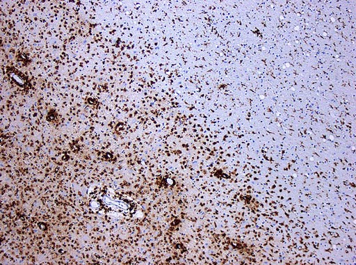 Image: A photomicrograph of a demyelinating multiple sclerosis lesion. Immunohistochemical CD68-staining highlights numerous macrophages (brown); original magnification 10x (Photo courtesy of Wikimedia).