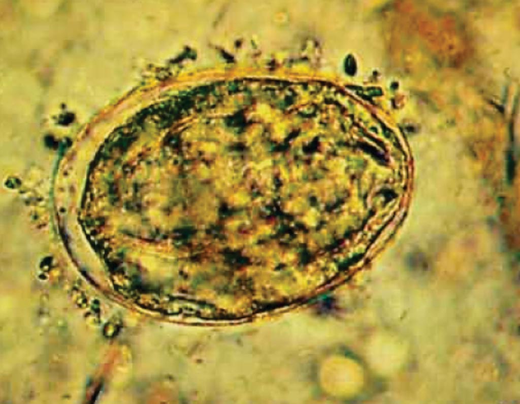 Image: A Schistosoma japonicum egg in feces (unstained, high power). The eggs of this fluke are smaller than those of S. mansoni and S. haematobium. They are ovoid and have a thin, clear shell and a spine or hook-like structure that may be inconspicuous (Photo courtesy of Florida Gulf Coast University).