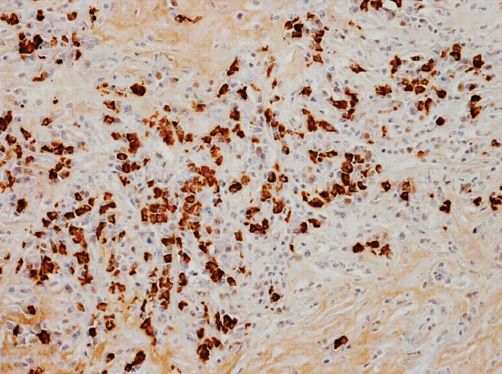 Image: Immunostaining for immunoglobulin G4 (IgG4) in IgG4-related inflammatory aortic aneurysm; abundant IgG4-positive plasma cell infiltration (Photo courtesy of Shiga University of Medical Science).