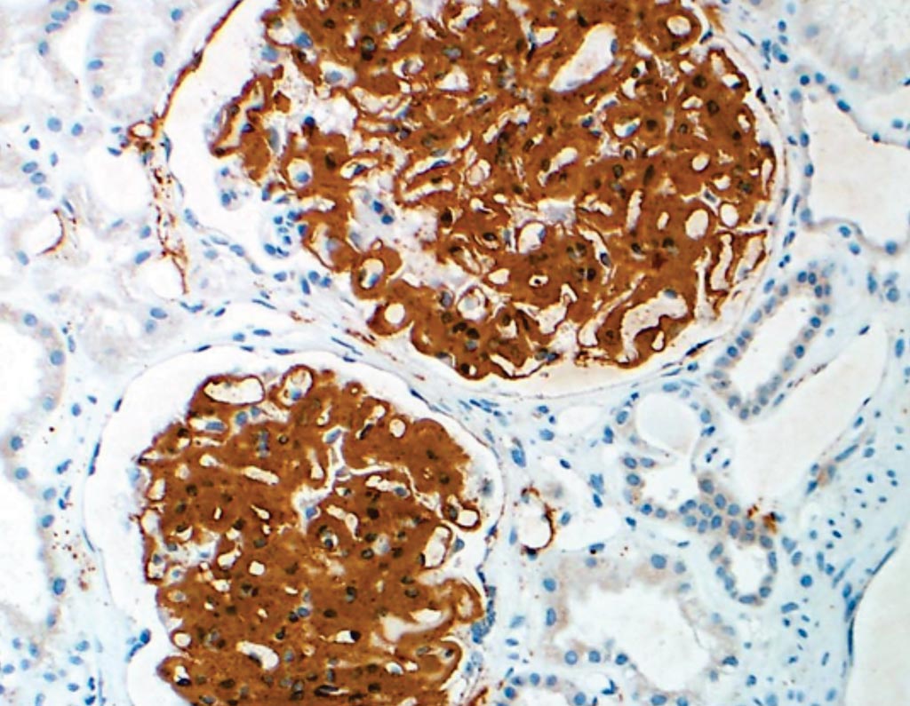 Image: An immunohistochemistry of the new biomarker DNAJB9 greatly improves diagnostic sensitivity for the rare kidney disease, fibrillary glomerulonephritis (Photo courtesy of Mayo Clinic).