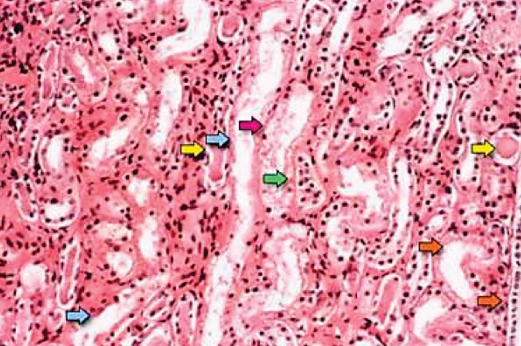 Image: A photomicrograph of a renal biopsy specimen suggesting acute tubular necrosis is the patchy or diffuse denudation of the renal tubular cells with loss of brush border (blue arrow) (Photo courtesy of the University of Alberta).