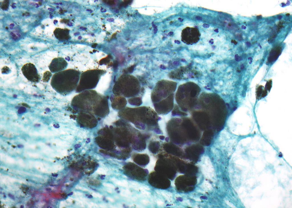 Image: Melanin protein (light refracting granular material at the center of the photomicrograph) in a pigmented melanoma (Photo courtesy of Wikimedia Commons).