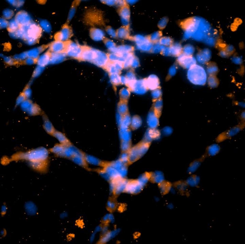 Image: Breast cancer cells were grown in a highly dense three-dimensional collagen matrix. After seven days the cells formed networks that resembled the early stages of blood vessel development. This photomicrograph shows representative structures observed in these environments after staining for cell nuclei (blue) and cytoskeletons (green) (Photo courtesy of the University of California, San Diego).