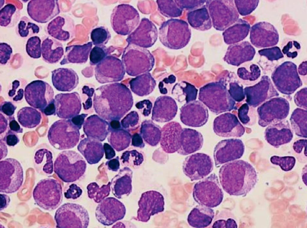 Image: A bone marrow aspirate from a patient with acute myeloid leukemia (Photo courtesy of Cytogenetic Oncology Laboratory).