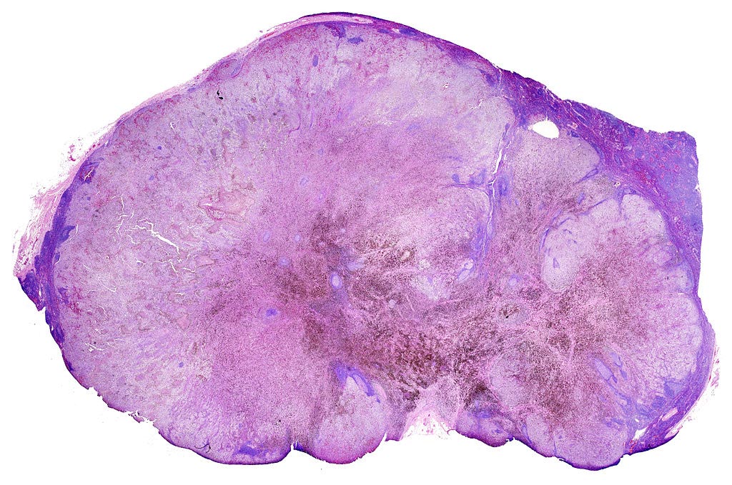 Image: A lymph node with almost complete replacement by metastatic melanoma. The brown pigment is focal deposition of melanin (Photo courtesy of Wikimedia Commons).