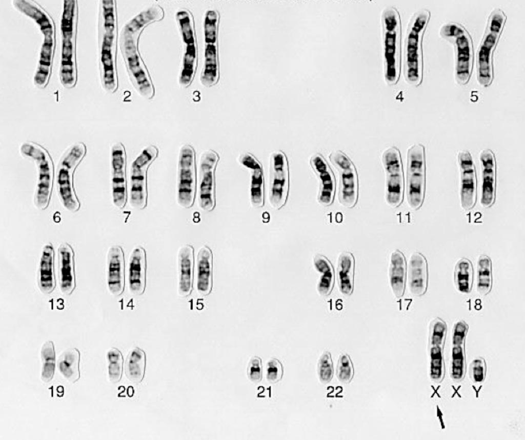 Image: Karyotyping of patient with Klinefelter syndrome, a chromosomal condition that affects male physical and cognitive development. Its signs and symptoms vary among affected individuals. This male has an extra X chromosome (Photo courtesy of Wellcome Trust).