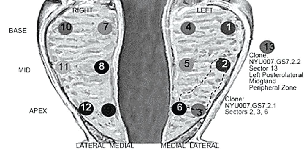 Image: A diagram of the human prostate gland, roughly the size and shape of a walnut, bisected by the urethra. The locations of each of an individual\'s 13 biopsy cores are indicated. Information obtained via single-cell sequencing from cells sampled from each core indicates the likely location of a cancerous tumor (dotted lines encompassing cores 2, 3 and 6) (Photo courtesy of Cold Spring Harbor Laboratory).