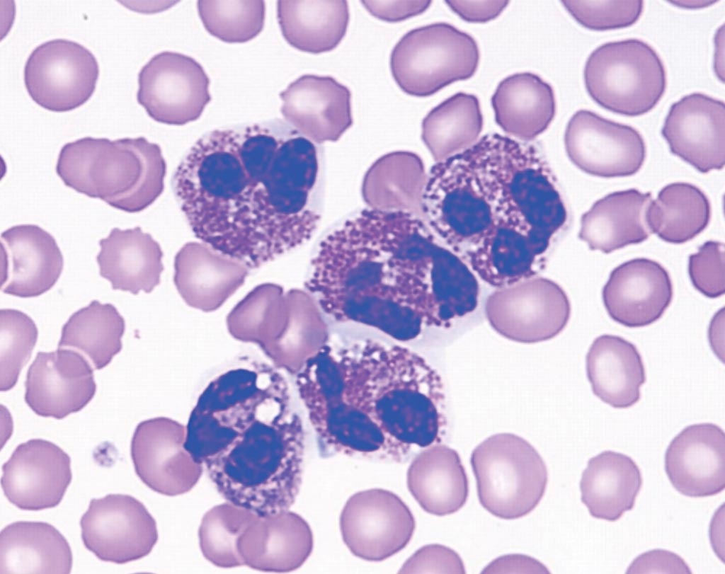 Image: Peripheral bloods smear showing five eosinophils, from a patient with eosinophilia (Photo courtesy of the Hospital for Sick Children, Toronto).