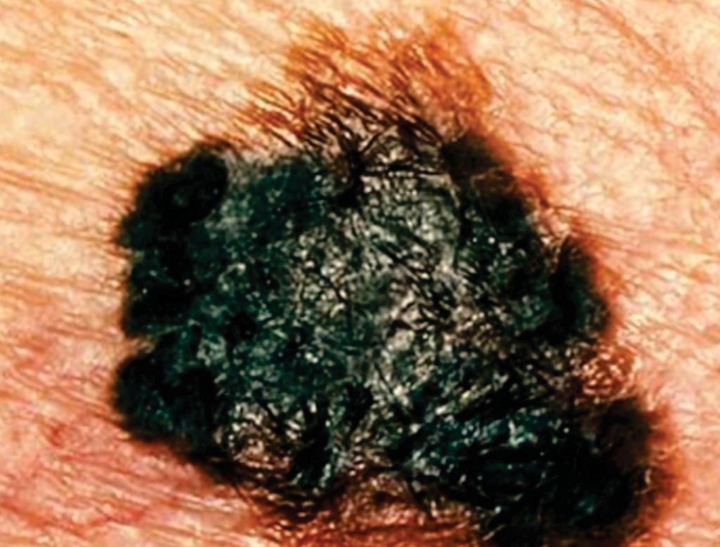 Image: This is a malignant melanoma, the most severe form of skin cancer. Melanomas, which arise from dysplastic nevi tend to be asymmetrical, with poorly defined borders and often with varied coloration (Photo courtesy of Skin Cancer Foundation).