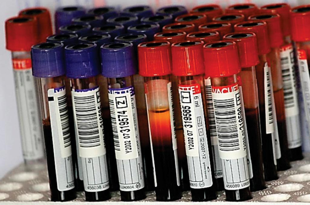 图像：收集人血样做检验；过多的检验可能引起医院获得性贫血（图片蒙Rebecca Zeffert惠赐）。
