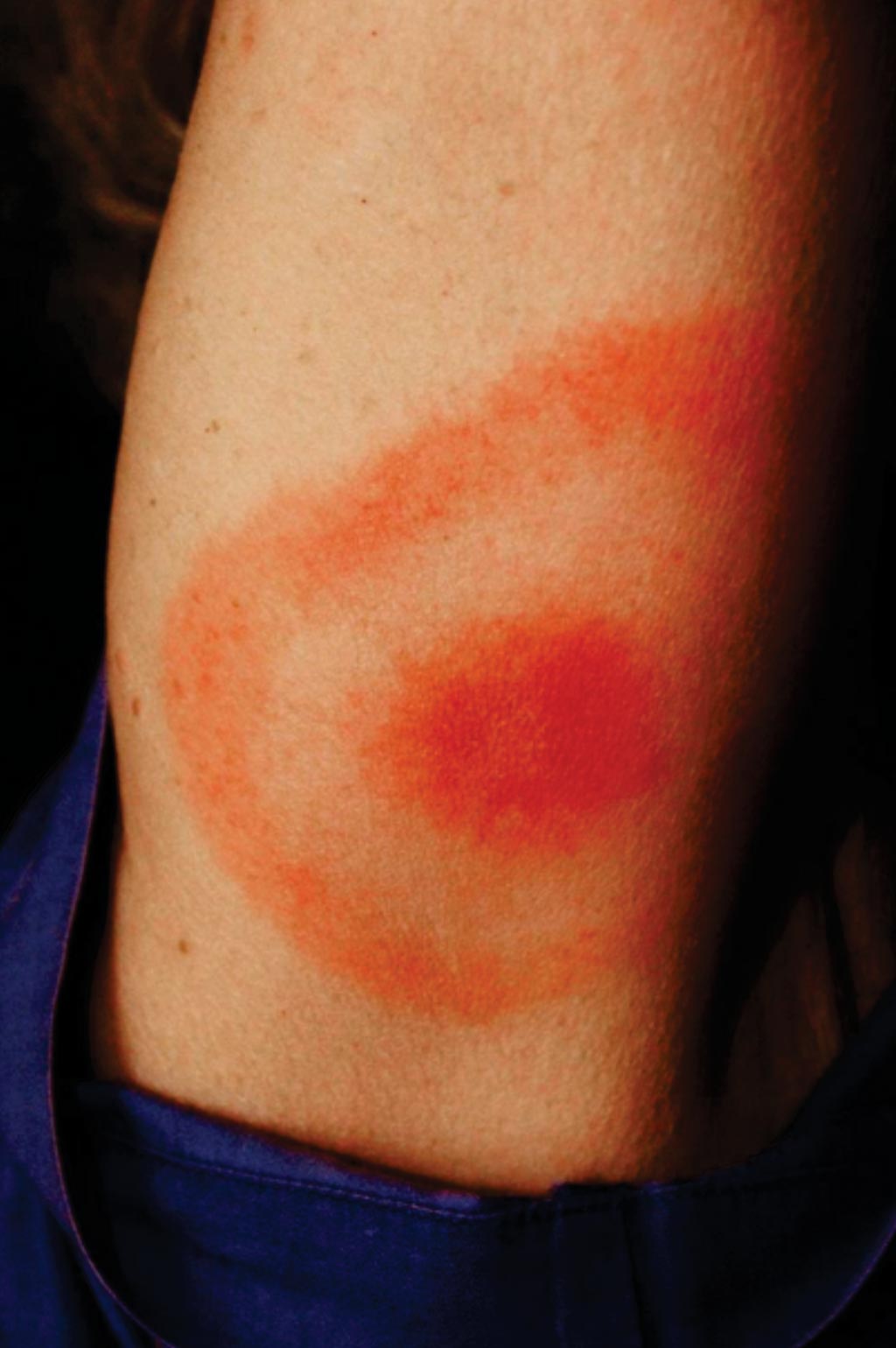 Image: This \"classic\" bullseye rash is also called erythema migrans. A rash caused by Lyme disease does not always look like this and approximately 25% of those infected with Lyme disease may have no rash, hence the need for new diagnostic tests (Photo courtesy of James Gathany/CDC).