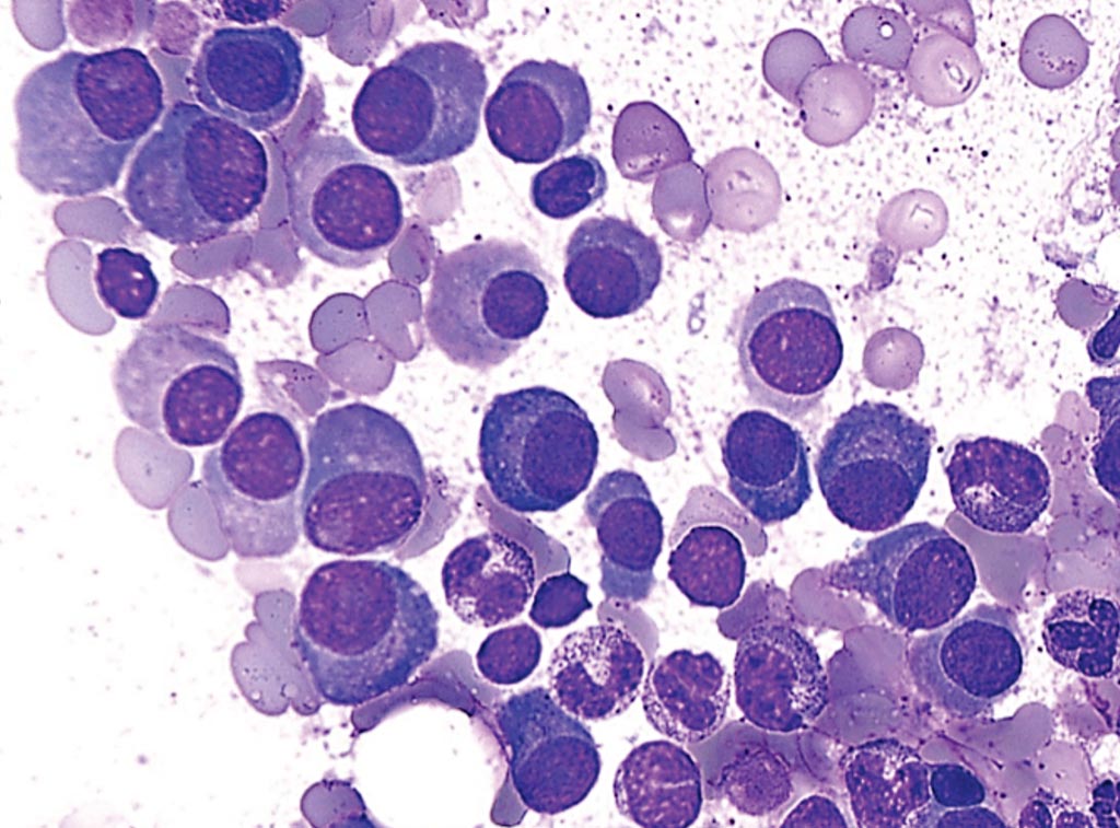 Image: Bone marrow biopsy of a patient with multiple myeloma, showing diffuse infiltration by neoplastic plasma cells, which can be recognized by the eccentric nucleus and perinuclear halo (Photo courtesy of Dr. Michael G. Bayerl).