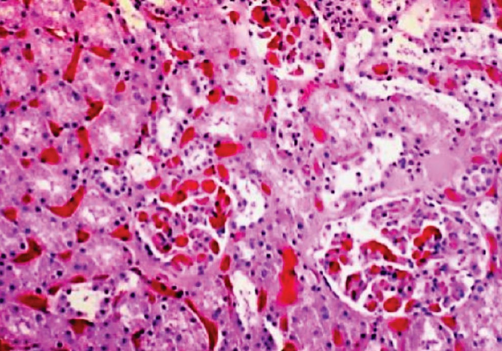Image: A histopathology of a fatal sickle cell crisis which resulted from sickling within the vasa recta within the kidney. Glomeruli are occluded by sickle cells (Photo courtesy of Dr. Vishai Ramteke).