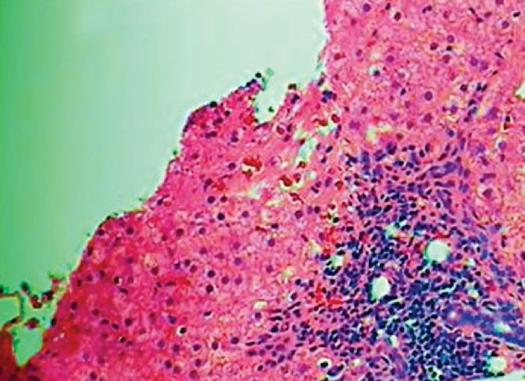 图片：感染活跃丙肝病毒的肝的组织病理图（图片蒙加利福尼亚太平洋医疗中心惠赐）。