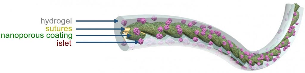 Image: An illustration of TRAFFIC (Thread-Reinforced Alginate Fiber for Islets enCapsulation), a novel removable implant device for control of type I diabetes (Photo courtesy of Cornell University).