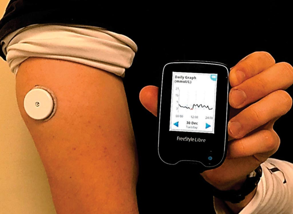 Image: The FreeStyle Libre continuous glucose monitoring system (Photo courtesy of Abbott).