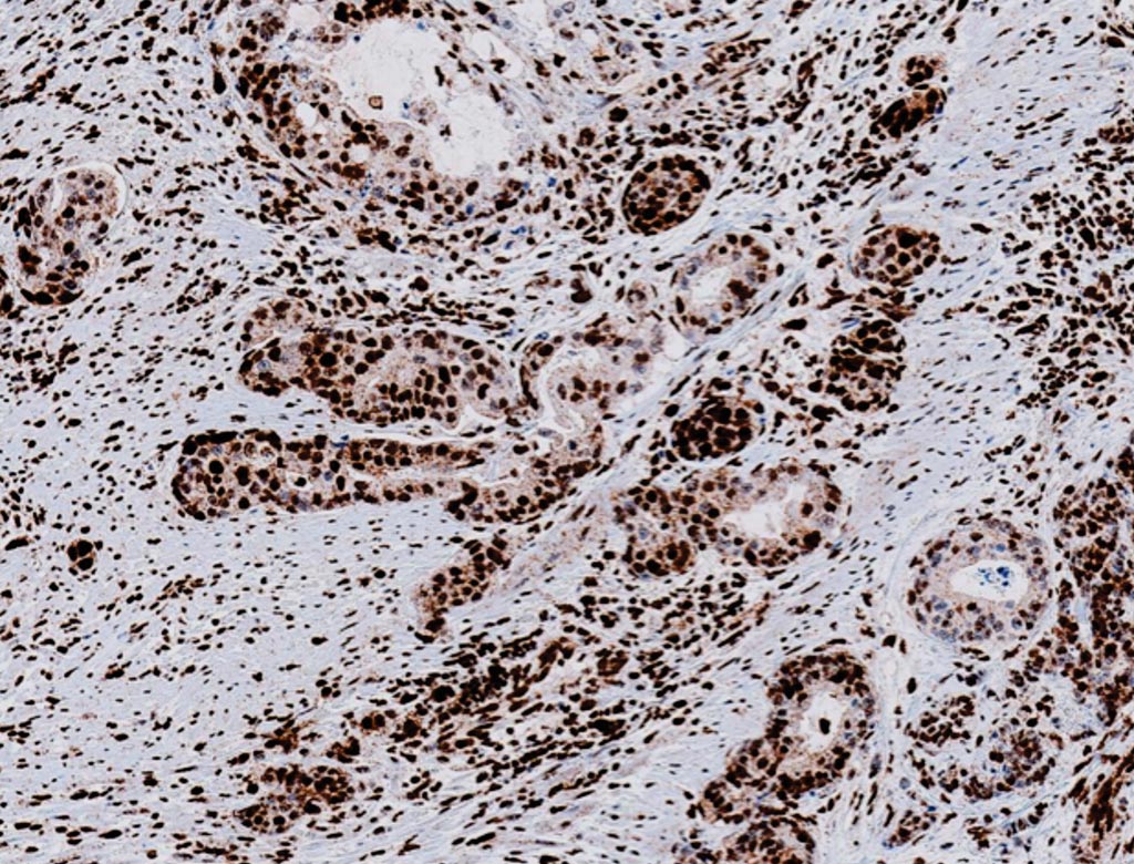 Image: Immunohistochemistry of MLH-1 (M1) Mouse Monoclonal Primary Antibody which is used to qualitatively identify human DNA mismatch repair (MMR) protein MLH1, expressed in the nucleus of normal proliferating cells. Loss of MLH1 is associated with colorectal and other cancers (Photo courtesy of Roche Tissue Diagnostics).