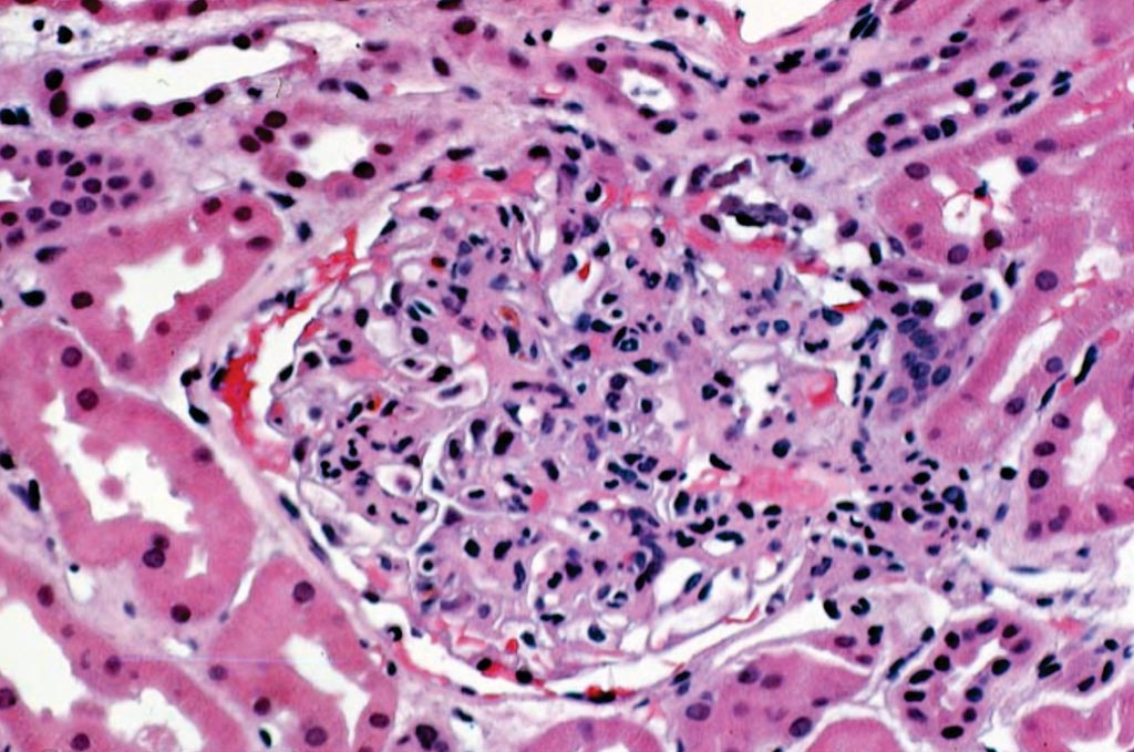 Image: An histology of an early post-transplant allograft biopsy showing a glomerulus with prominent neutrophil infiltration. A few neutrophils are also seen in the interstitium. These findings can be seen in early stages of hyperacute rejection (Photo courtesy of the University of Pittsburgh Medical Center).