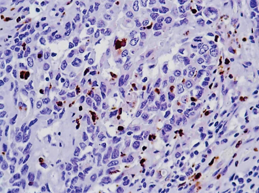 图片：用髓过氧化物酶抗体染色的人胃腺癌样本（图片蒙罗氏生命科学公司惠赐）。