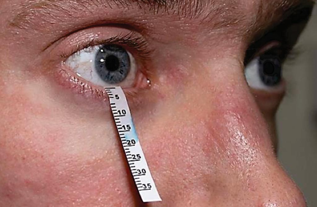Image: The Schirmer’s test is an invasive filter paper strip folded over the lower lid to absorb the tear film for five minutes. The tears collected on the Schirmer’s strips can be analyzed for biomarkers (Photo courtesy of Innovative Eye Care).