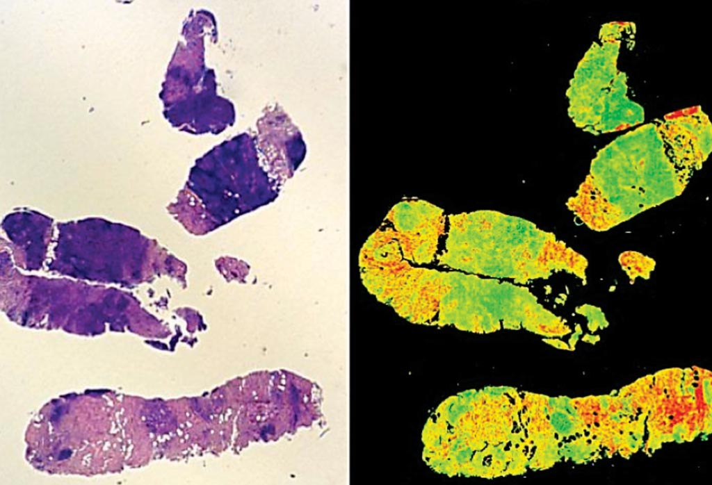 Image: New cutting edge technology can be used to grade cancer tumors, eradicating human subjectivity. A traditional stained H+E biopsy (L) and a Digistain view (R) (Photo courtesy of Imperial College London).
