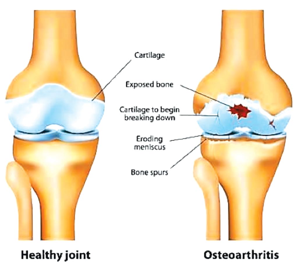 Image: A graphic comparison of a healthy joint and osteoarthritis (Photo courtesy of European Union Cordis).
