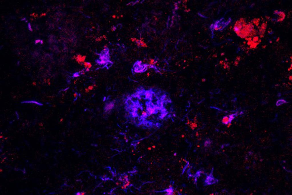 Image: Antibodies against APOE (red) bind to amyloid plaques (blue) in brain tissue from people with Alzheimer\'s disease. Investigators have found that the antibody can sweep away the damaging plaques, at least in mice, which could lead to a therapy for the devastating disease (Photo courtesy of Monica Xiong, Washington University School of Medicine).