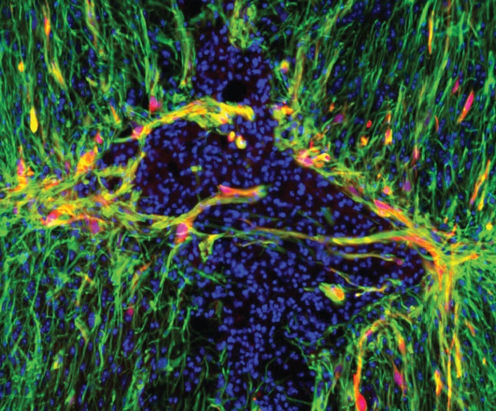 Image: Genetically modified astrocytes (red) line the lesion border in the injured spinal cord. A new mouse study showed that triggering a gene inside astrocytes activated the star-shaped cells and may improve the brain’s ability to heal from a range of debilitating conditions, from stroke to concussions and spine injuries (Photo courtesy of Dr. Meifan Amy Chen, University of Texas Southwestern Medical Center).