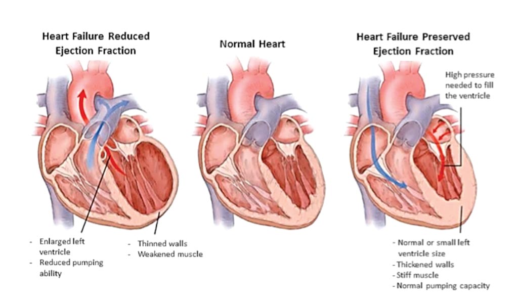Image: A diagram of two different forms of heart failure compared with a normal heart (Photo courtesy of The Medical University of South Carolina).