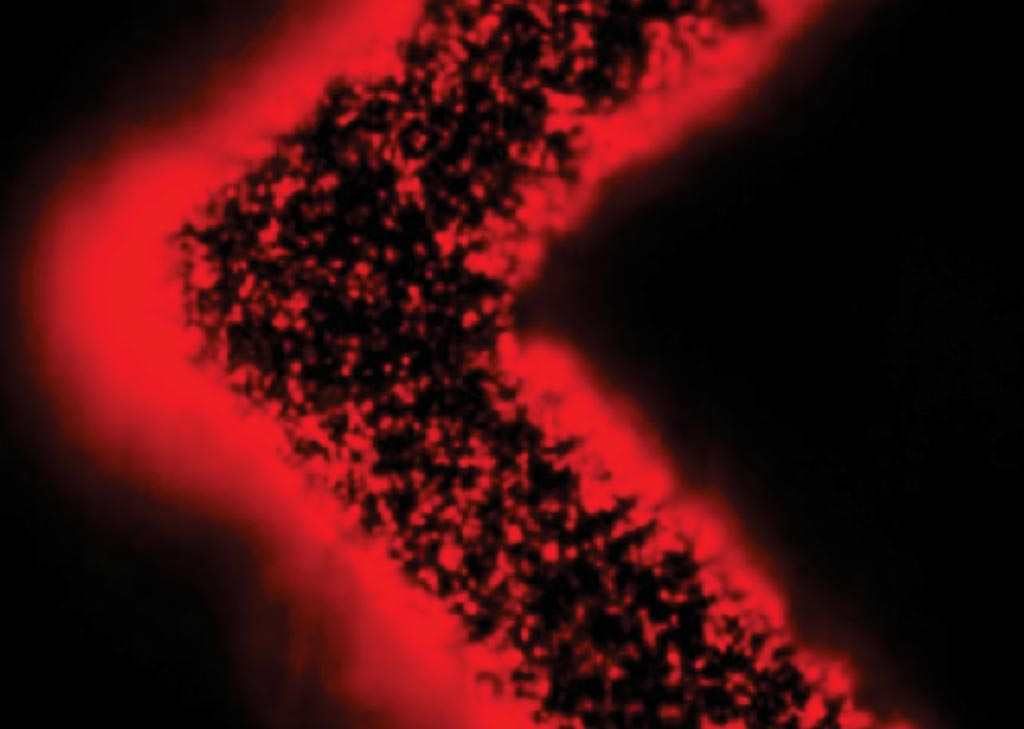 EVHB芯片表面上捕捉到的病人肿瘤排出的细胞外囊泡（红色）（图片蒙Shannon Stott博士惠赐）。
