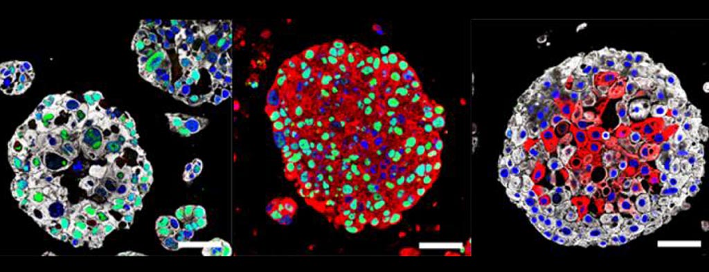 Image: Organoids created from the bladder cancers of patients mimic the characteristics of each patient\'s tumor and may be used in the future to identify the best treatment for each patient (Photo courtesy of Columbia University Medical Center).