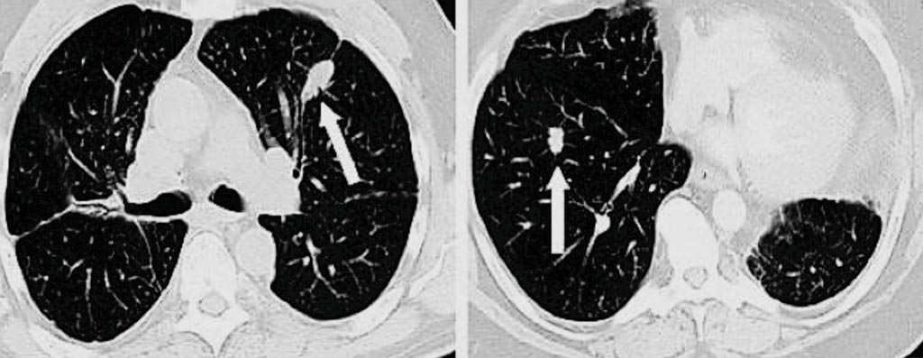 两名肺结节患者的计算机断层扫描成像(CT)。左边的箭头指向良性（非癌）结节，而右边的箭头显示一小块肺癌（图片蒙谷地医院肺癌中心惠赐）。