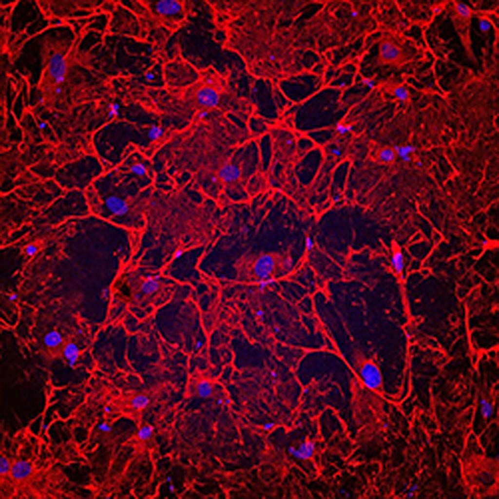 Image: A photomicrograph showing fibrotic heart cells from a patient who had heart failure. The cells have an elaborate fibronectin matrix (shown in red), which causes fibrosis and heart damage (Photo courtesy of Cincinnati Children\'s Hospital Medical Center).