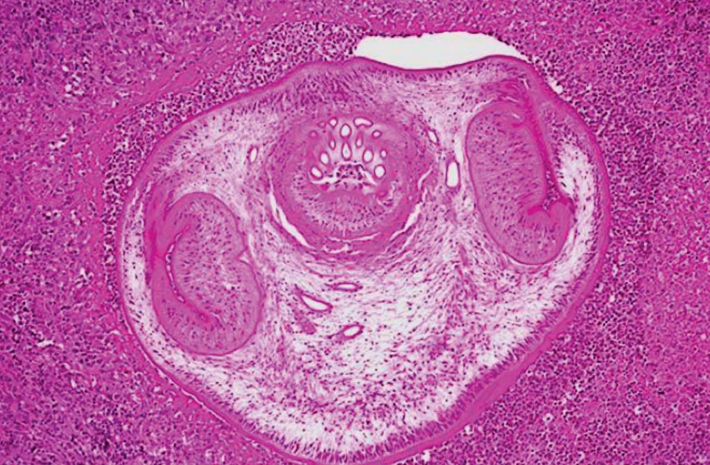 Image: A photomicrograph of a brain tissue specimen revealed the presence of hooklets in a case of cysticercosis, an infection due to the ingestion of eggs of a pork tapeworm, Taenia solium (Photo courtesy of the University of Pennsylvania Medical Center).