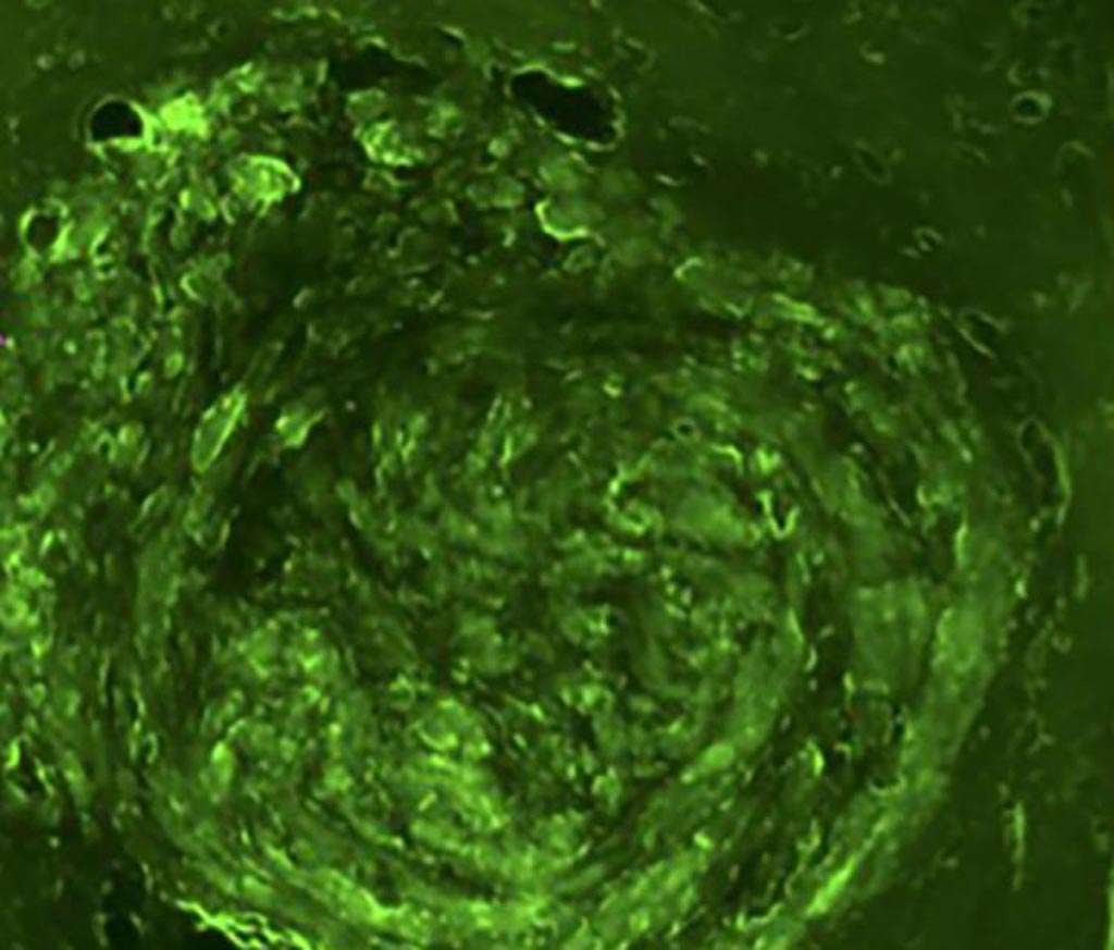 Image: A brain tumor in a mouse that has been treated with green fluorescent protein-transduced glioblastoma cells (Photo courtesy of Washington University).