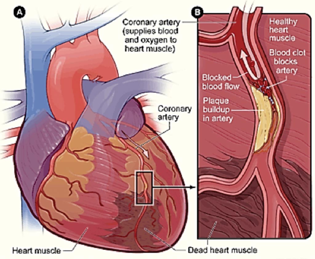 Image: A diagram of the causes of coronary heart disease (Photo courtesy of US National Heart, Lung and Blood Institute).