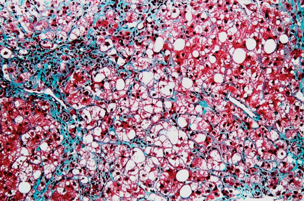 Гистопатологическая микрофотография биопсии печени со стеатогепатитом, демонстрирующим дегенерацию гепатоцитов с раздуванием – форму апоптоза (фото любезно предоставлено Nephron).