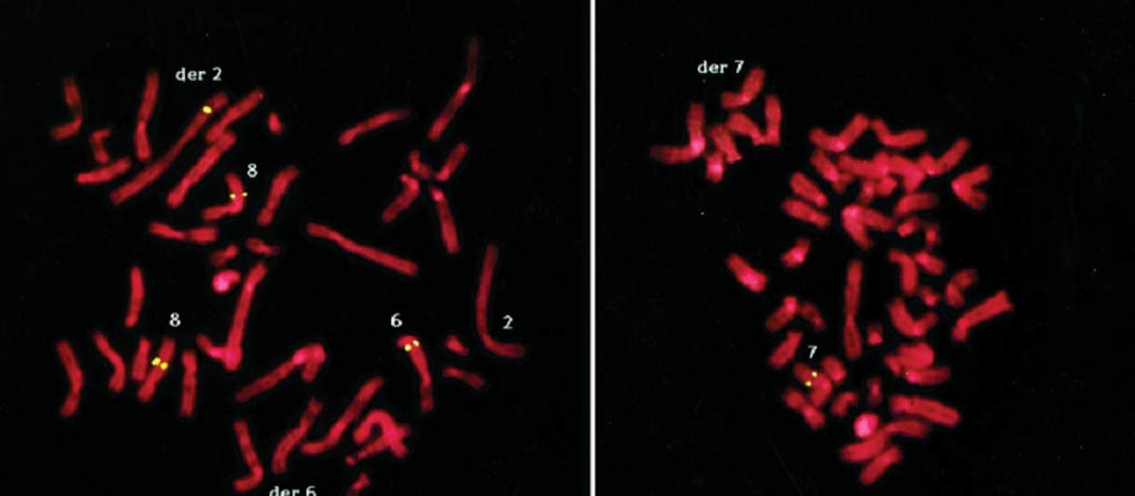 Image: A microsatellite analysis of a patient with balanced chromosomal rearrangements (Photo courtesy of Human Genetics).