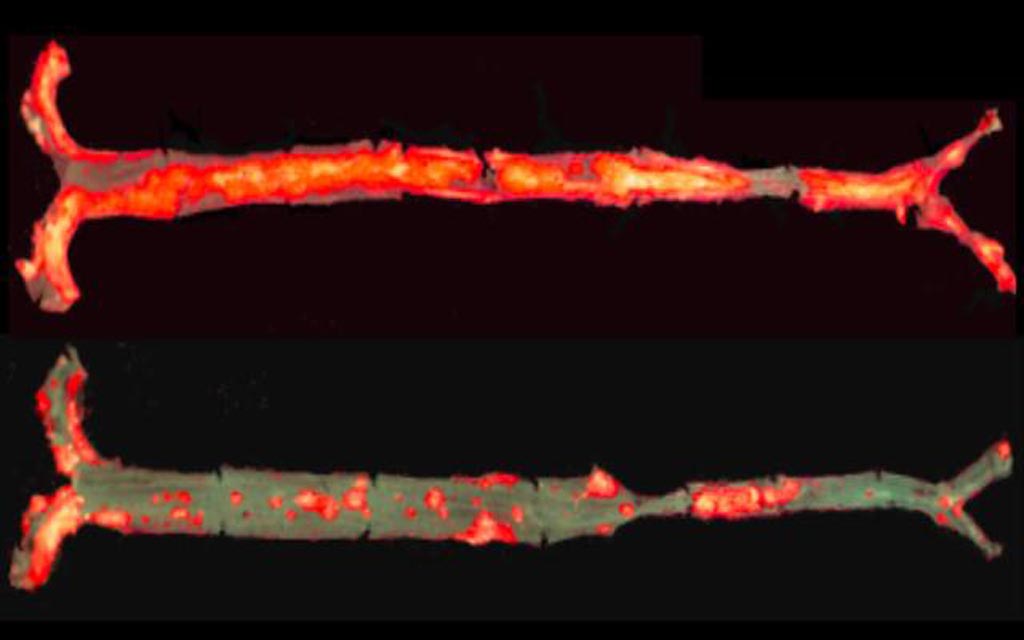 Image: The aorta of a mouse model of atherosclerosis on a high-fat diet for 12 months (top) has significantly more plaques (bright red) than the aorta of the same type of mouse that also produces the anti-inflammatory E06 antibody (bottom) (Photo courtesy of the University of California, San Diego).